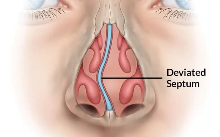 intervento-per-setto-nasale-deviato.webp