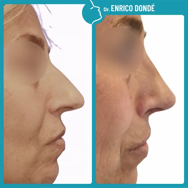 Naso femminile prima e dopo rinoplastica per ridurre la lunghezza (deproiezione della punta)