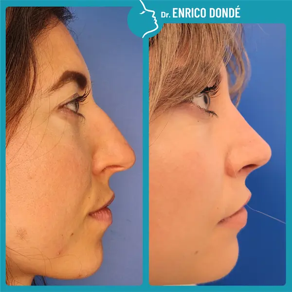 prima e dopo riduzione gobba naso e riposizionamento ossa nasali