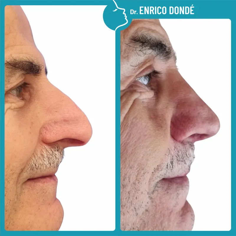 Prima e dopo rinoplastica per accorciare naso uomo molto lungo