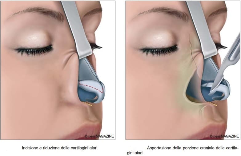 incisione-riduzione-cartilagini-alari-e-asportazione-porzione.jpg