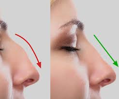 Video relativo a rimuovere gobba sul naso con limatura
