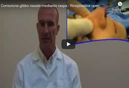 video che descrive intervento di intevento a naso con la gobba