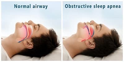 Rimuovere le ostruzioni del naso e migliorare la respirazione nel sonno