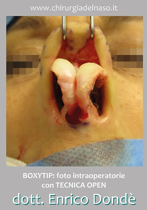 boxytip-foto-intraoperatoria-tecnica-open-2.webp