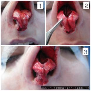Riduzione del volume della punta del naso
