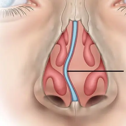 Operazione per setto nasale deviato