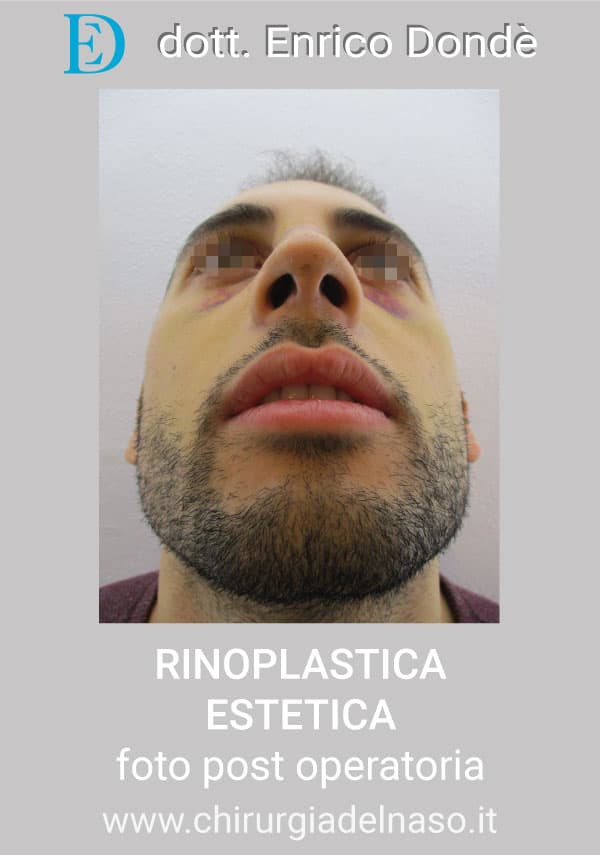 RinoplasticaEstetica-POST02.jpg