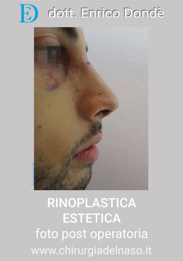 RinoplasticaEstetica-POST03.jpg