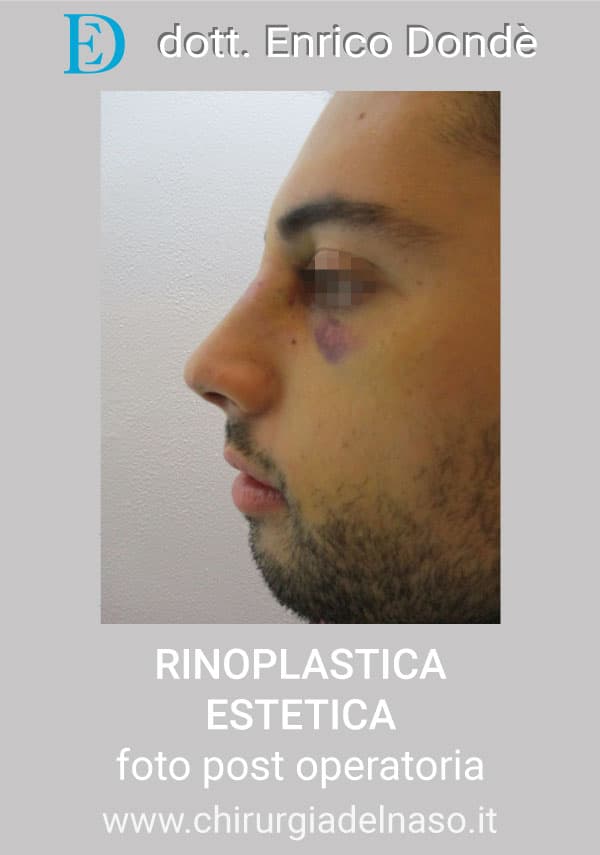 RinoplasticaEstetica-POST04.jpg