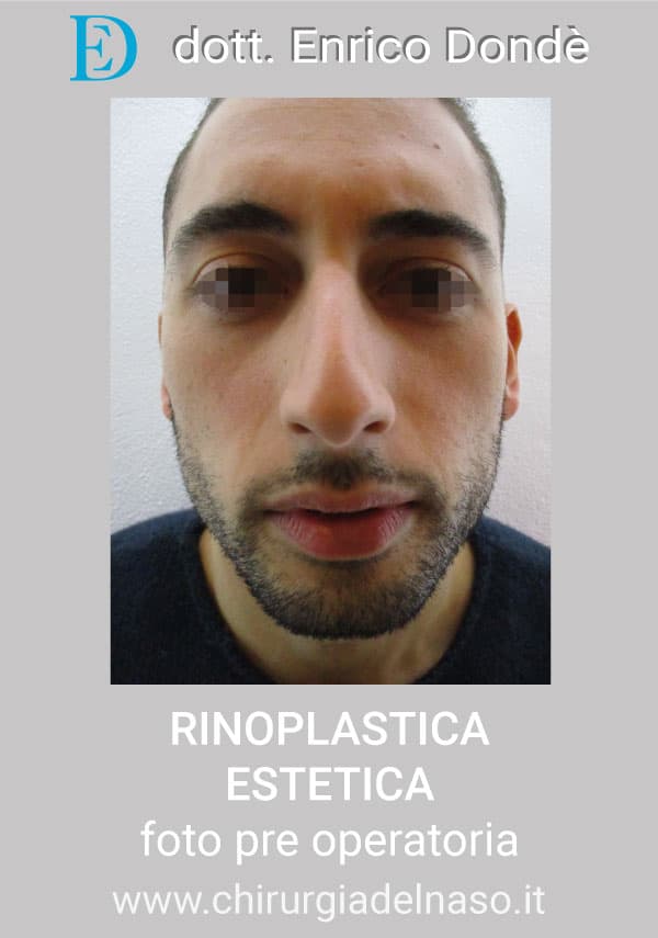 RinoplasticaEstetica-PRE01.jpg