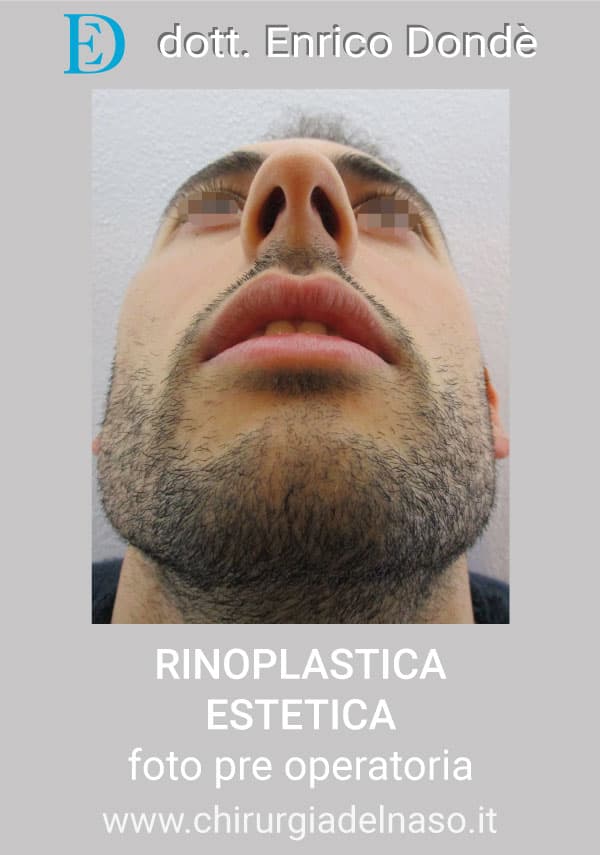 RinoplasticaEstetica-PRE02.jpg