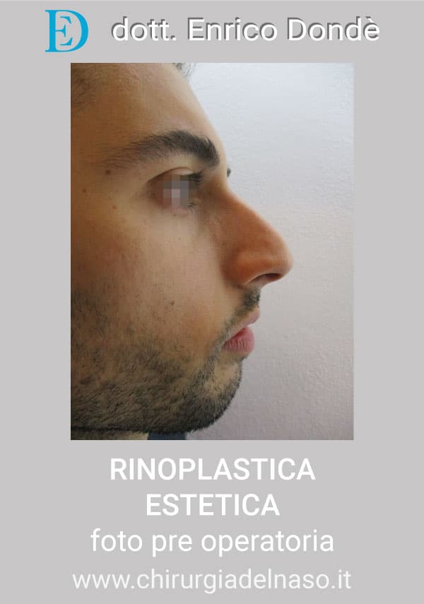 RinoplasticaEstetica-PRE03.jpg
