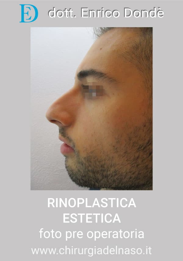 RinoplasticaEstetica-PRE04.jpg