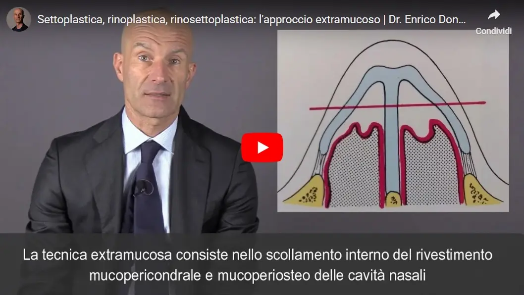 tecnica-extramucosa-rinoplastica-videodescrizione.webp
