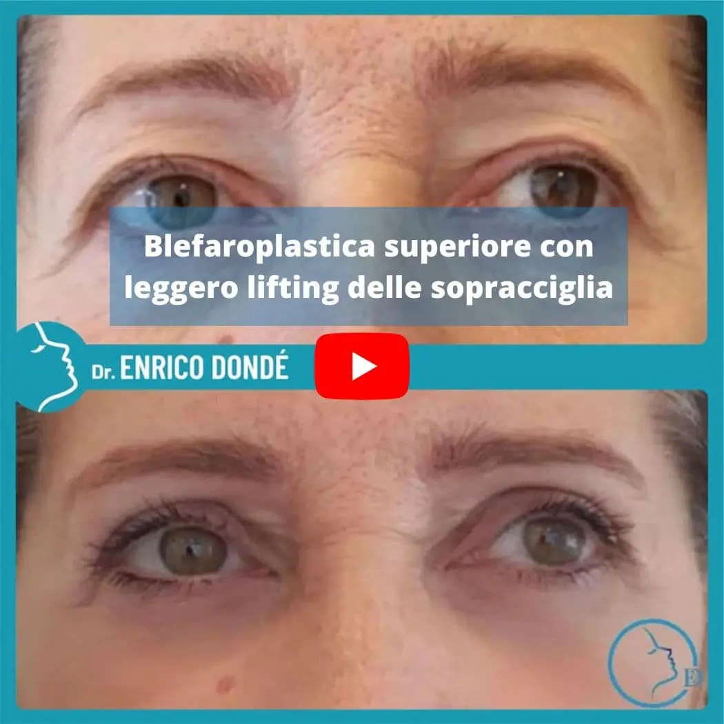 101-blefaroplastica-superiore-pre-post-video-youtube.webp