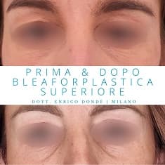 Foto prima e dopo di blefaroplastica per togliere borse dagli occhi