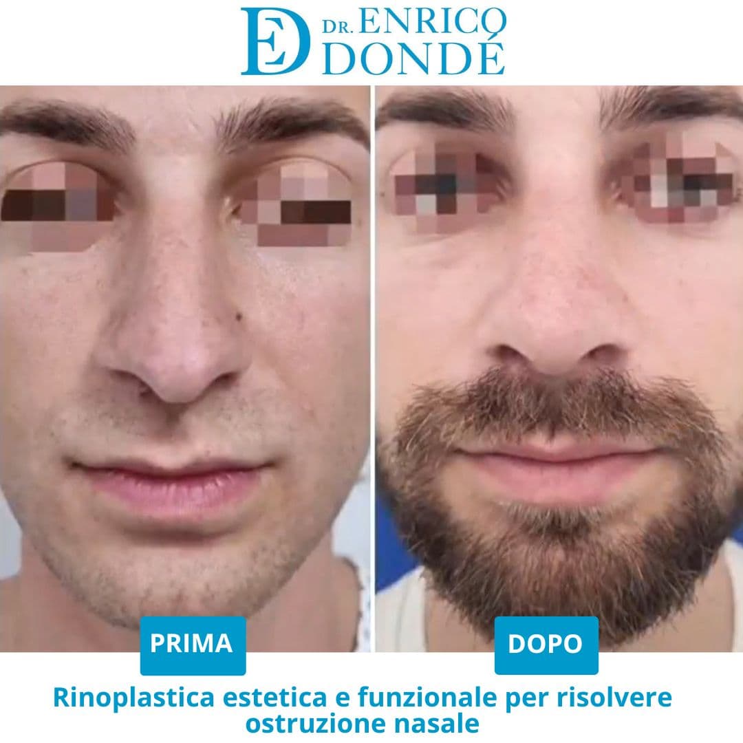 106-Rinoplastica-estetica-e-funzionale-per-ostruzione-naso-vista-frontale.jpg