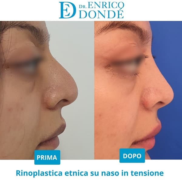 Foto prima e dopo rinosettoplastica su naso etnico paziente donna