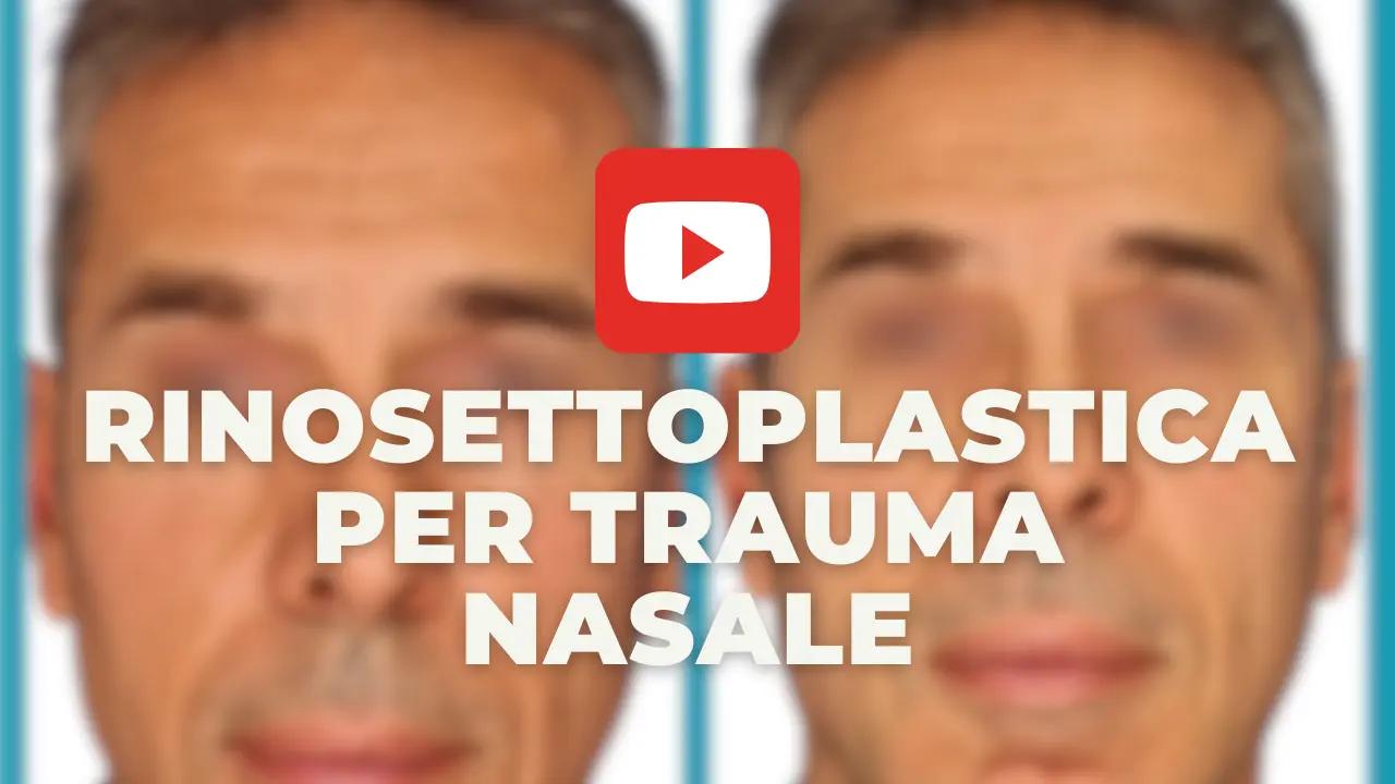 148-min-yt-sito-rinosettoplastica-per-trauma-nasale.webp