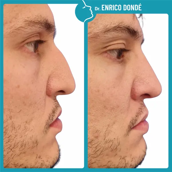 Foto prima e dopo di naso operato per traumi da sport