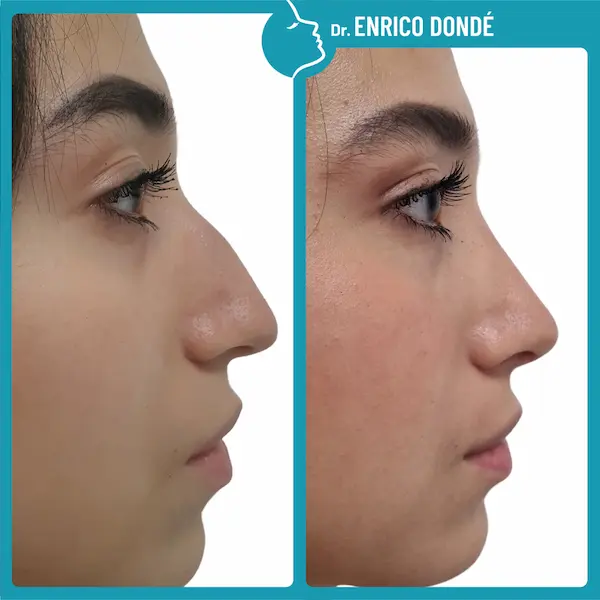 foto prima e dopo su naso donna correzione gobba e aumento struttura punta