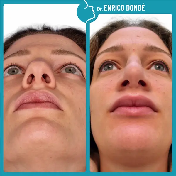 Prima e dopo correzione della punta naso su paziente giovane donna