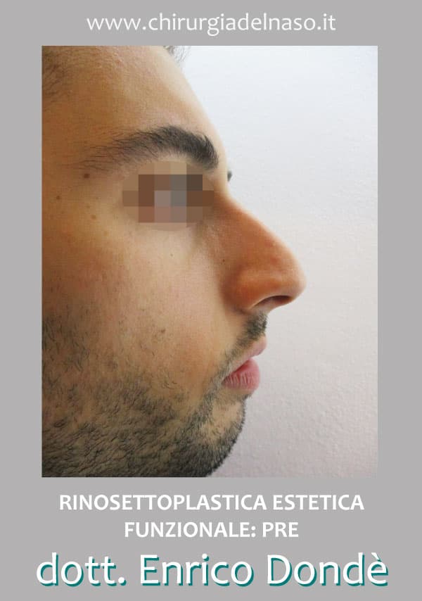 RinosettoplasticaEsteticaFunzionale-PRE-dx.jpg