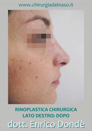 Riduzione proiezione piramide nasale - lato destro - dopo