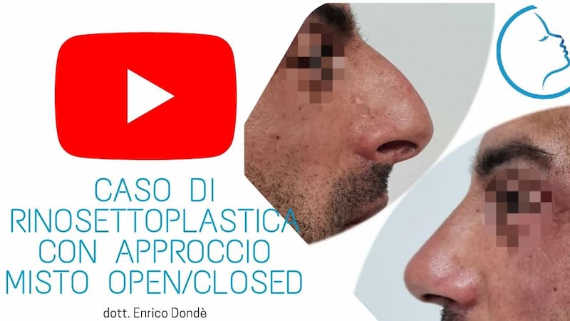 anteprima-video-caso-rinosettoplastica-maschile-approccio-open-closed.jpg