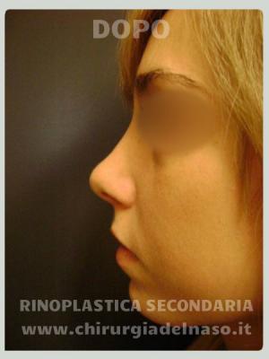 Rinoplastica secondaria su ragazza giovane