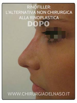 big_alternativa-non-chirurgica-rinoplastica-rinofiller-dopo_primadopo_150_i9uV6.jpg