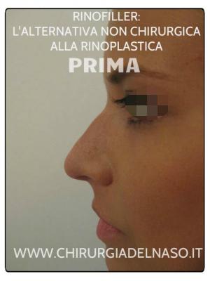 big_alternativa-non-chirurgica-rinoplastica-rinofiller-prima_primadopo_150_fx58T.jpg