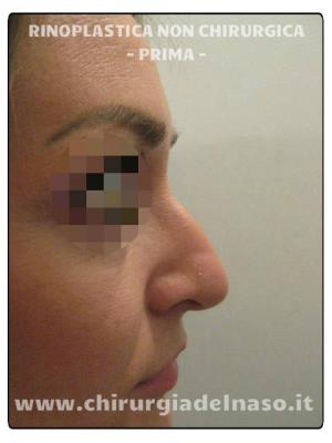 big_correggere-il-profilo-nasale-con-la-medicina-estetica-1_primadopo_149_n36cj.jpg