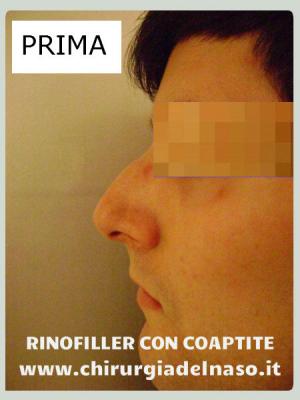 big_correzione-profilo-nasale-prima_primadopo_83_Ac7Ew.jpg