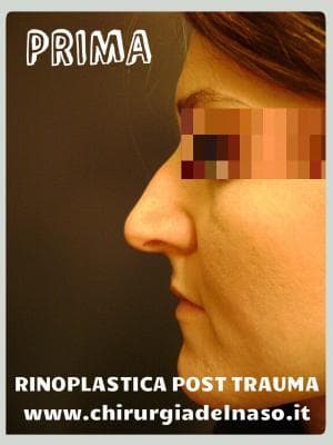 big_correzione-setto-nasale-deviato-prima-profilo_primadopo_33_7A0Rr (1).jpg