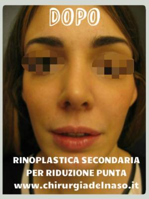 Foto Rinoplastica per riduzione larghezza della punta del naso