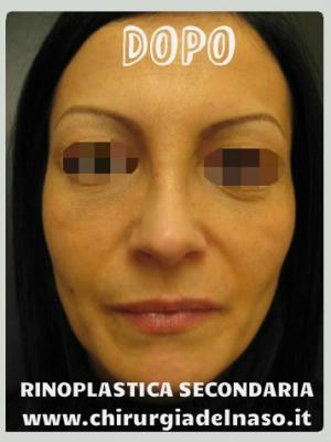 Foto frontale post intervento rinoplastica su paziente donna per correzione della punta del naso