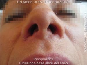 Rinoplastica secondaria per ridurre la base alare del naso