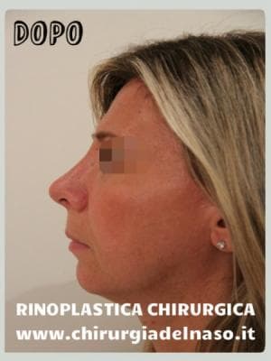 foto dopo 3 mesi rinoplastica gibbo, piramide e punta