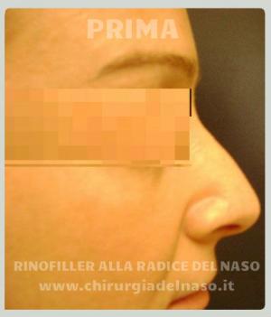 big_rhinofiller-radice-naso-prima-dx2_primadopo_88_Dzxxy.jpg
