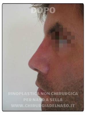 foto trattamento con rinofiller su naso a sella