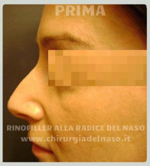 big_rinofiller-radice-naso-prima-sx2_primadopo_88_GeCM6.jpg