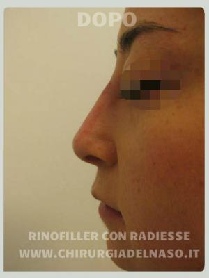 big_rinofiller-radiesse-rinoplastica-secondaria-non-chirurgica-DOPO_primadopo_137_IJX5q.jpg