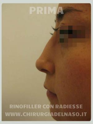 big_rinofiller-radiesse-rinoplastica-secondaria-non-chirurgica-PRIMA_primadopo_137_e7eZI.jpg