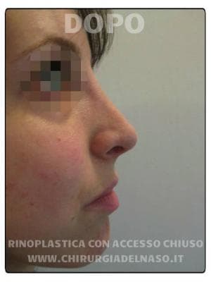 big_rinoplastica-chirurgica-profilo-destro-post_primadopo_126_4PoFd (1).jpg