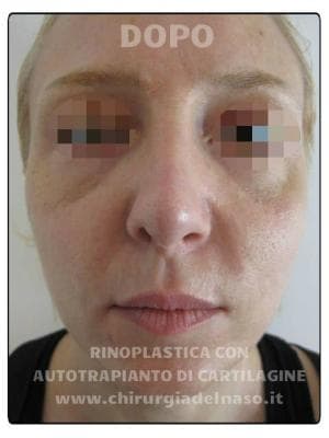 Foto prima e dopo rinoplastica eseguita mediante innesti di cartilagine