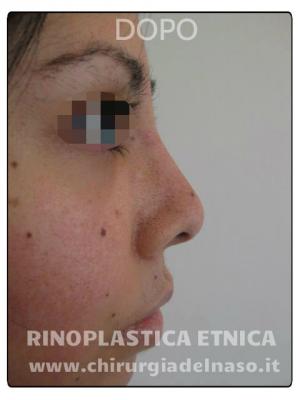 big_rinoplastica-etnica-foto-dopo-1-mese_primadopo_139_7cuTU.jpg