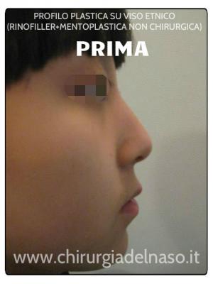 big_rinoplastica-etnica-non-chirurgica-mentoplastica-additiva-non-chirurgica-prima_primadopo_157_mB0