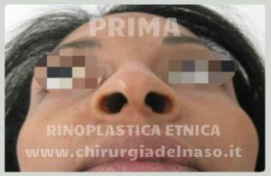 big_rinoplastica-etnica-prima-basso_primadopo_8_91LkQ.jpg
